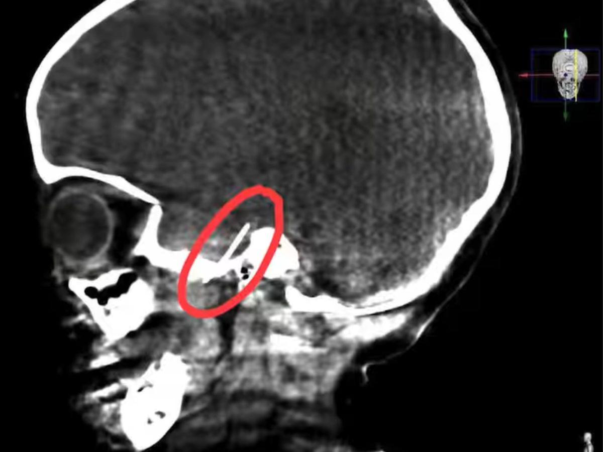 La radiografía que se le realizó a la menor mostraba la aguja incrustada.