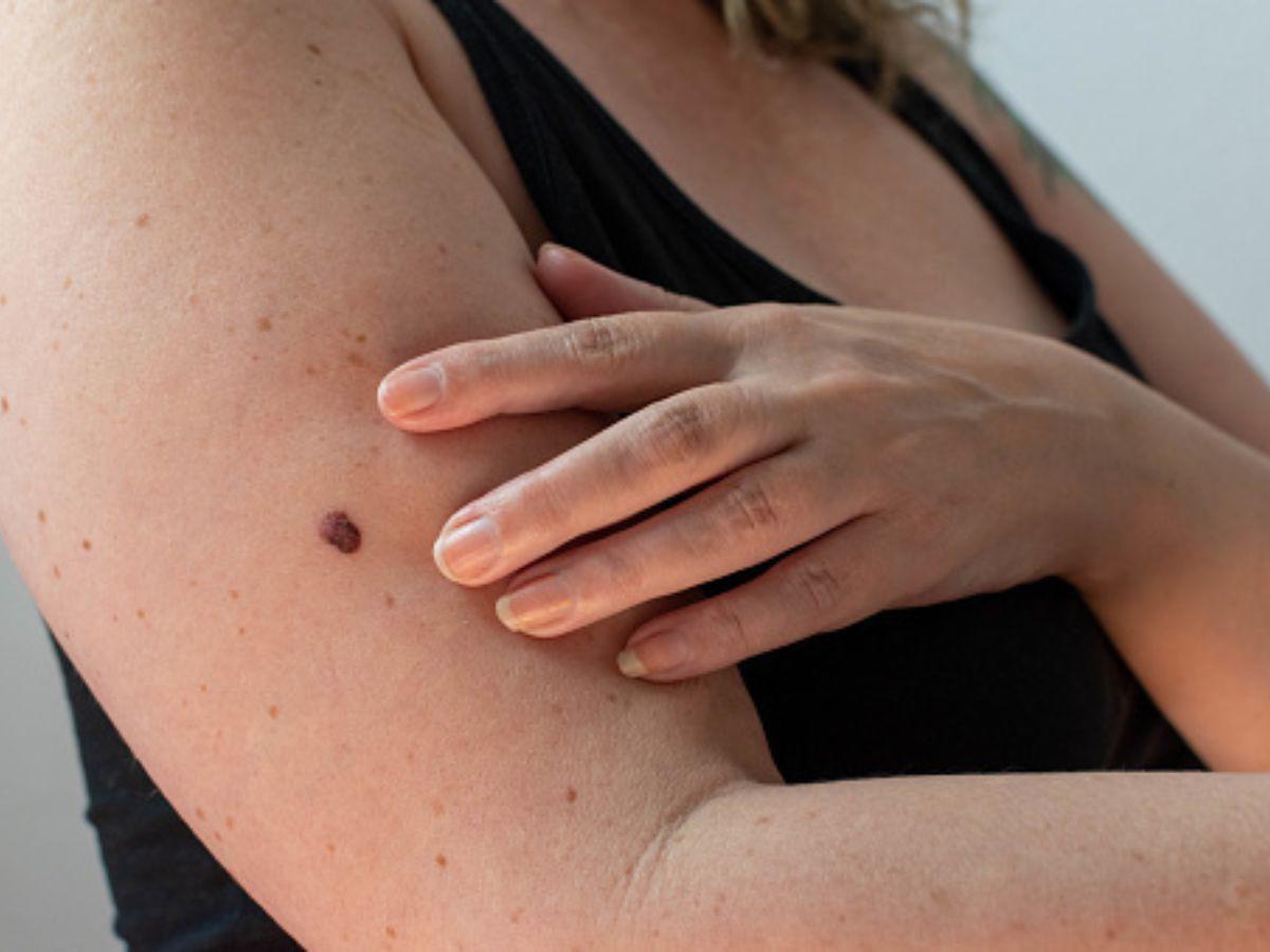Expertos prevén un aumento en casos de cáncer de piel por altas temperaturas en Honduras