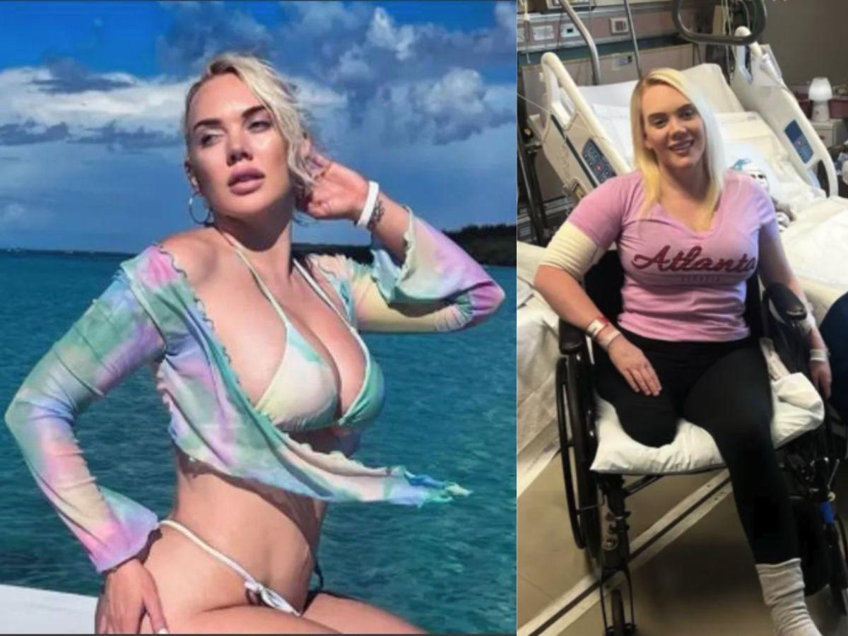 Modelo pierde una de sus piernas a causa de una bacteria “carnívora”