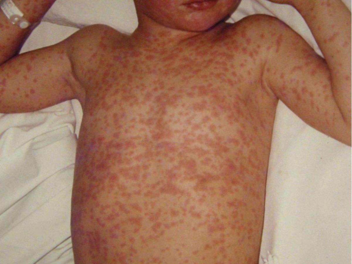 ¿Cuáles son los síntomas del sarampión, la enfermedad que pone en alerta a Honduras?