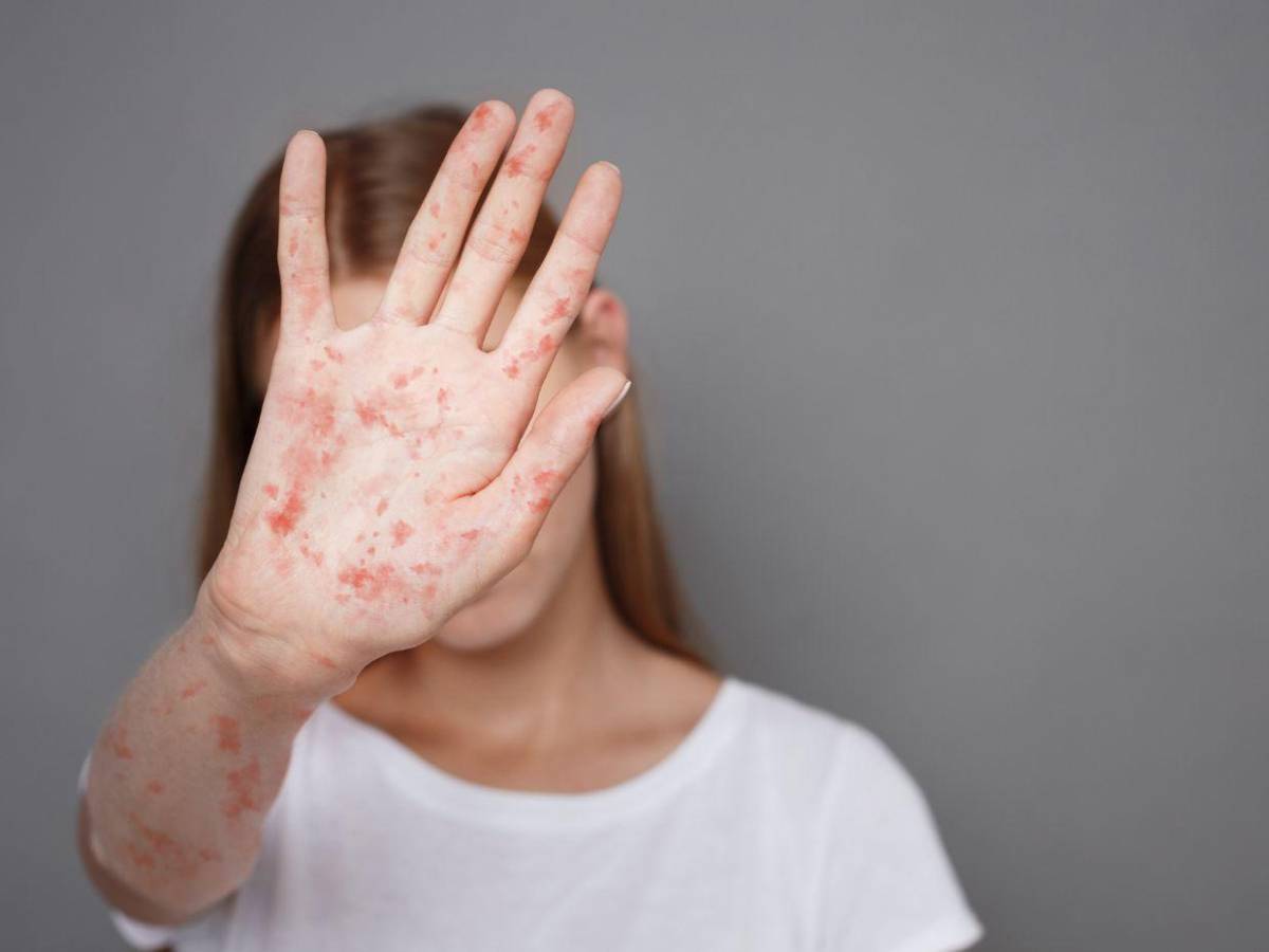 Brote de sarampión en Carolina del Sur deja a 139 niños en cuarentena