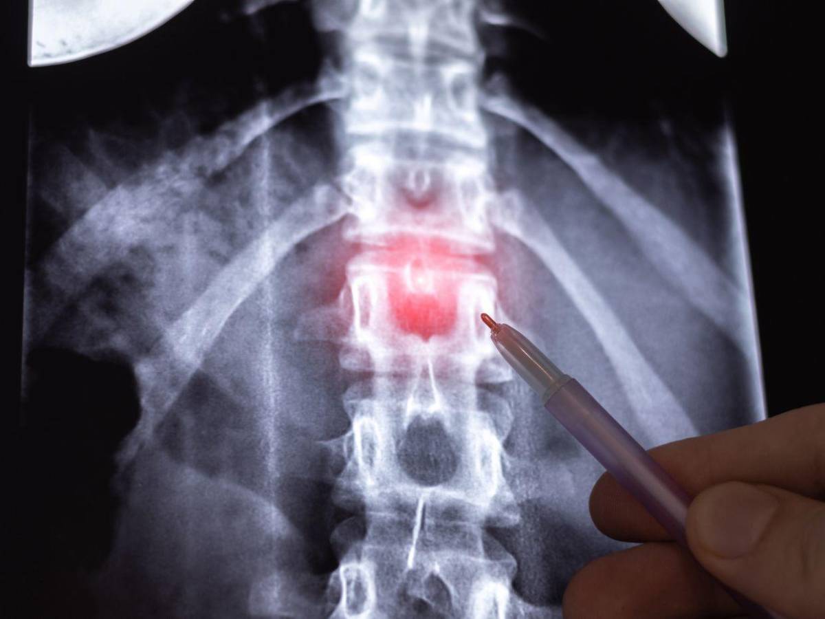 Las lesiones de espalda más comunes y cómo prevenirlas