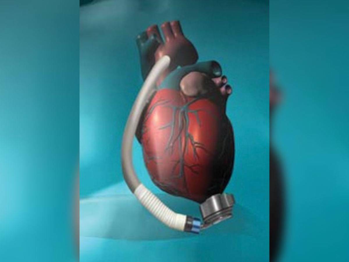 ¿Qué es el corazón artificial de L10.5 millones que necesita diputado de Libre para vivir?