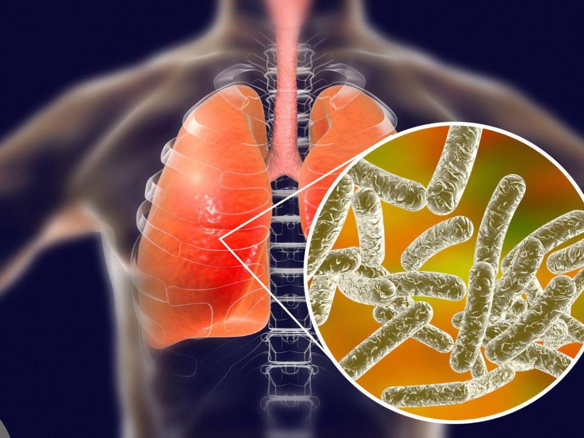¿Qué es la enfermedad del legionario, infección que tiene en alerta a Nueva York?