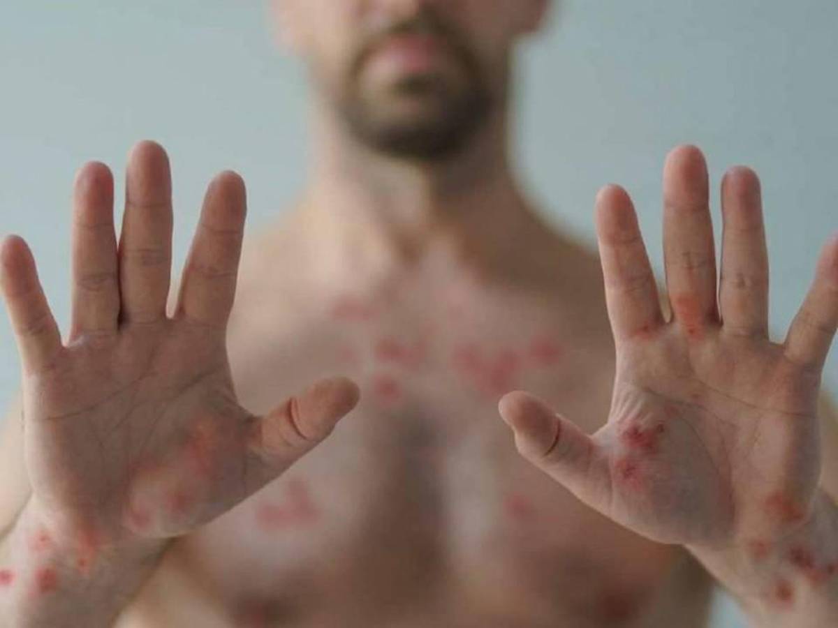 Viruela del mono en Honduras: ¿Qué se sabe del segundo caso detectado en la capital?