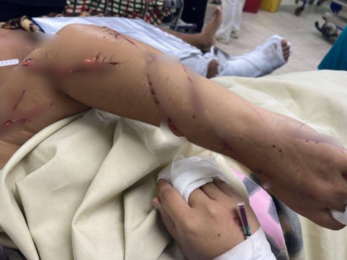 Recibió 30 machetazos: Yensy Guzmán quedó completamente desfigurada tras brutal ataque de su esposo