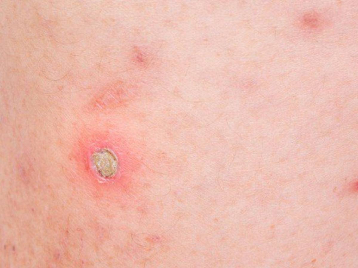 ¿Cuáles son los síntomas de la enfermedad del gusano barrenador en humanos?