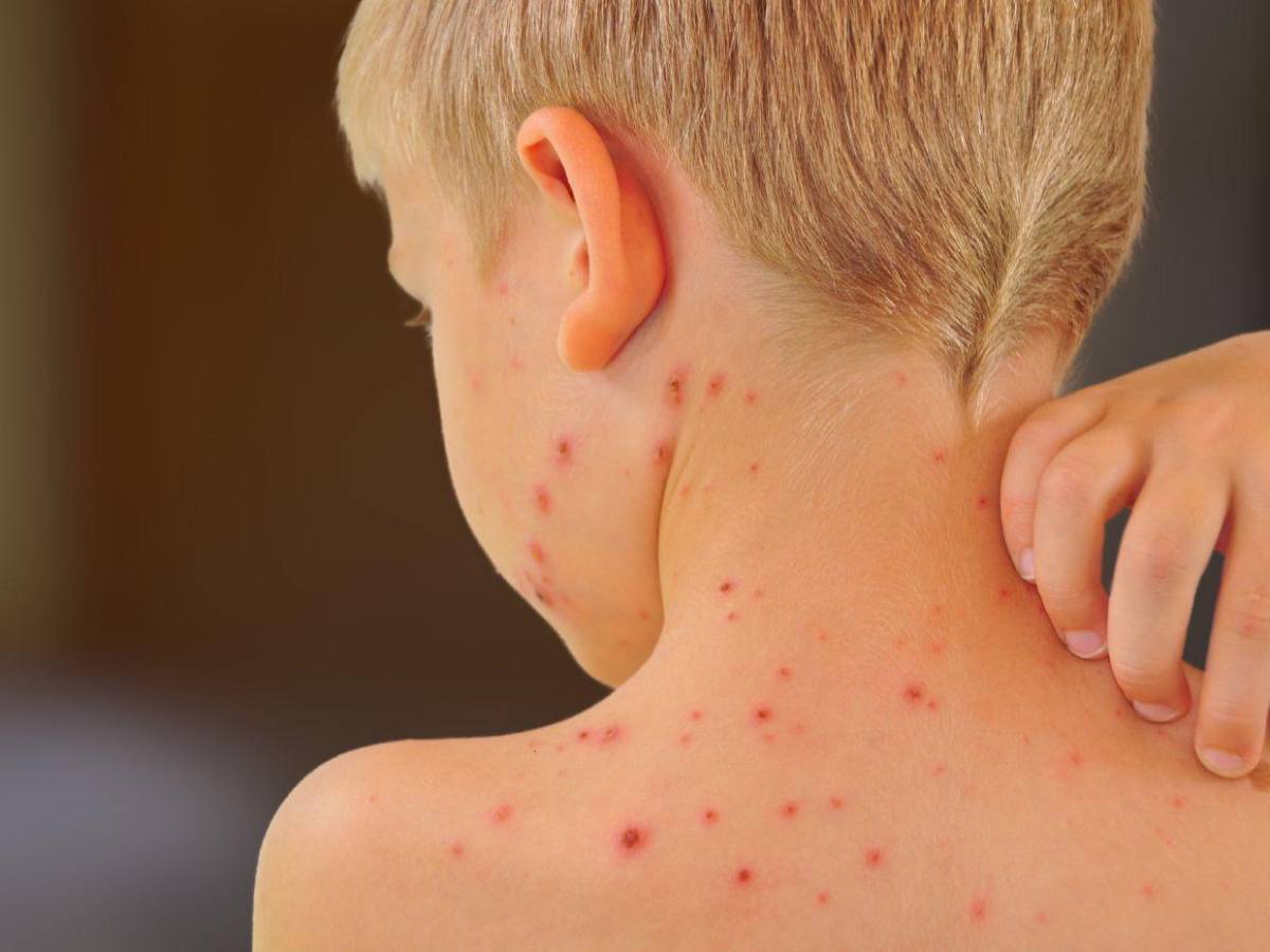 Brote de sarampión en Carolina del Sur deja a 139 niños en cuarentena