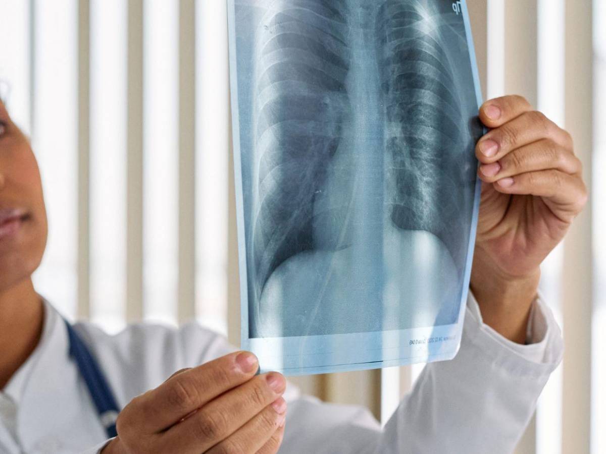 Monoterapia: ¿En qué consiste el tratamiento que enfrenta Carlos Zelaya por cáncer?