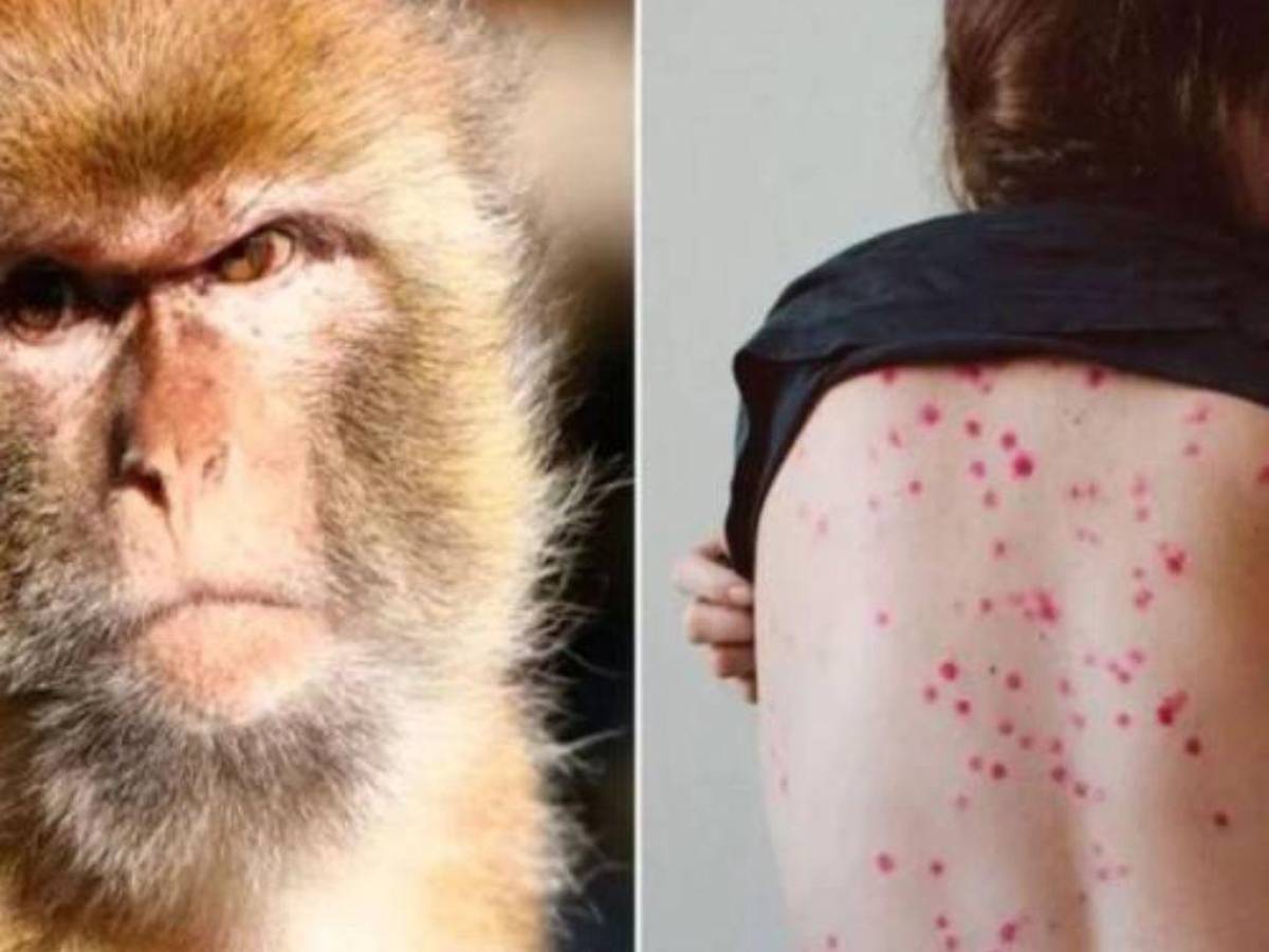 ¿Cuánto dura la viruela del mono dentro del cuerpo? Estudio científico lo revela