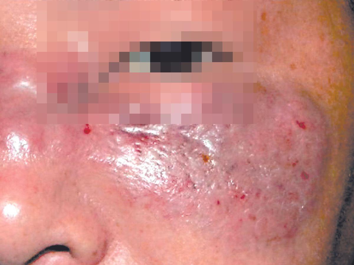 Hongo negro: Ya se registran dos casos y un muerto por esta enfermedad