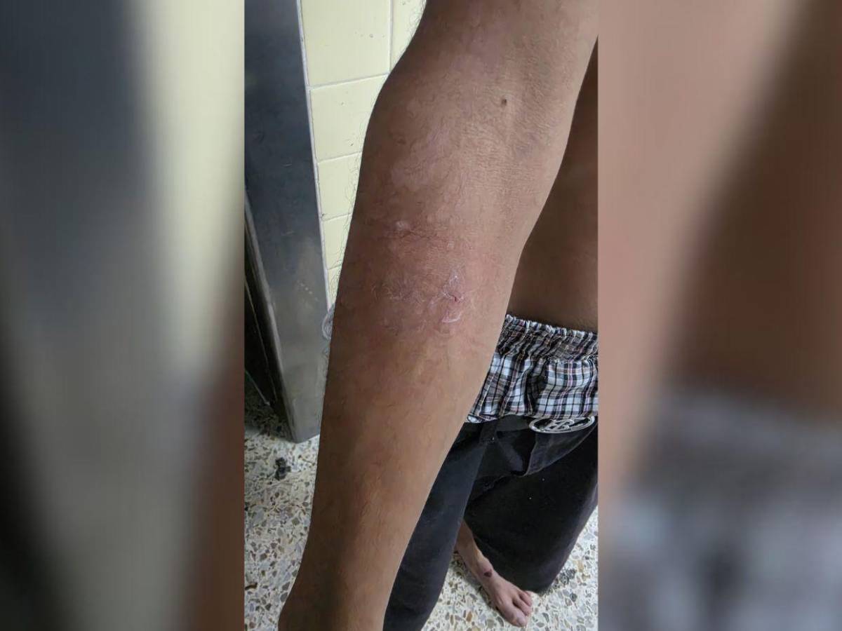 Incendio en barrio San Martín deja cuatro quemados; entre ellos dos adultos mayores