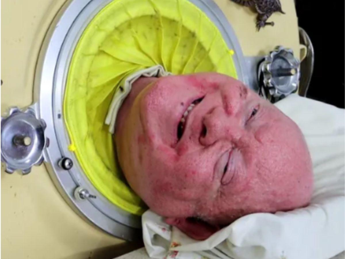 Muere Paul Alexander, el hombre que vivió en un “pulmón de hierro” por 70 años