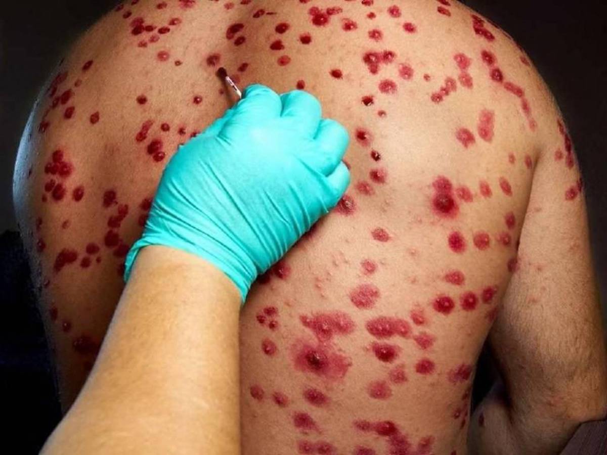 Aunque la población tenga temor por contagiarse de la viruela del mono como el coronavirus, los expertos en salud afirman que no son similares las formas.