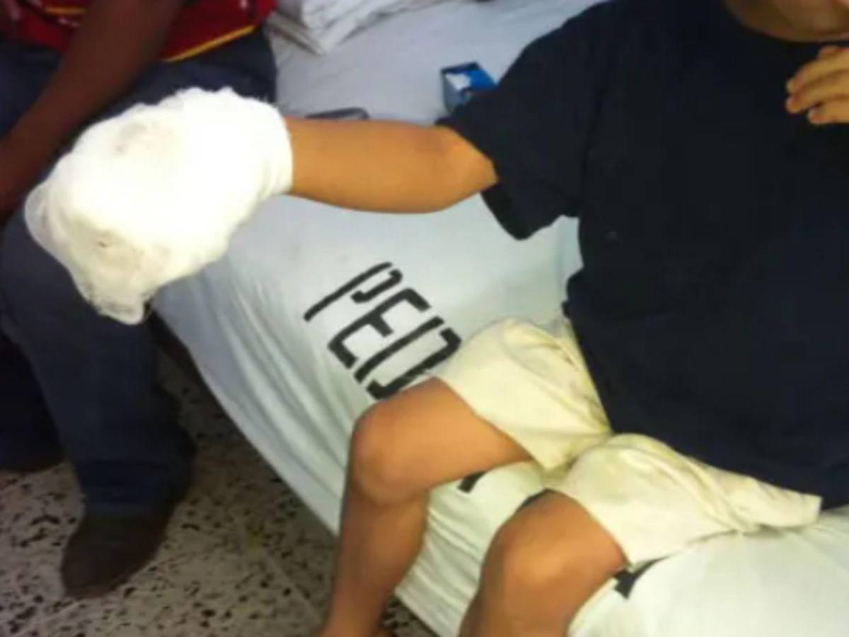 Más de 10 quemados por pólvora se registraron durante las fiestas de Fin de Año