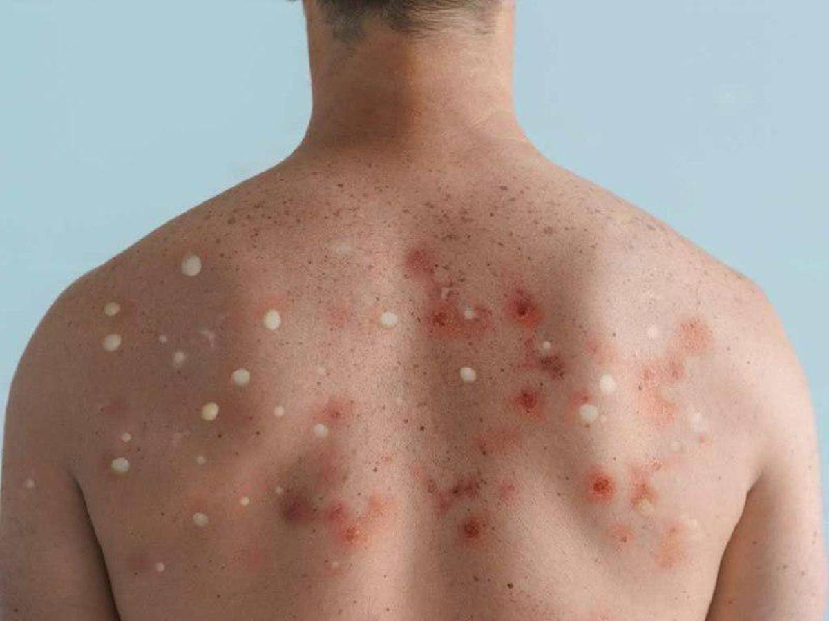 Honduras confirma el segundo caso de viruela del mono