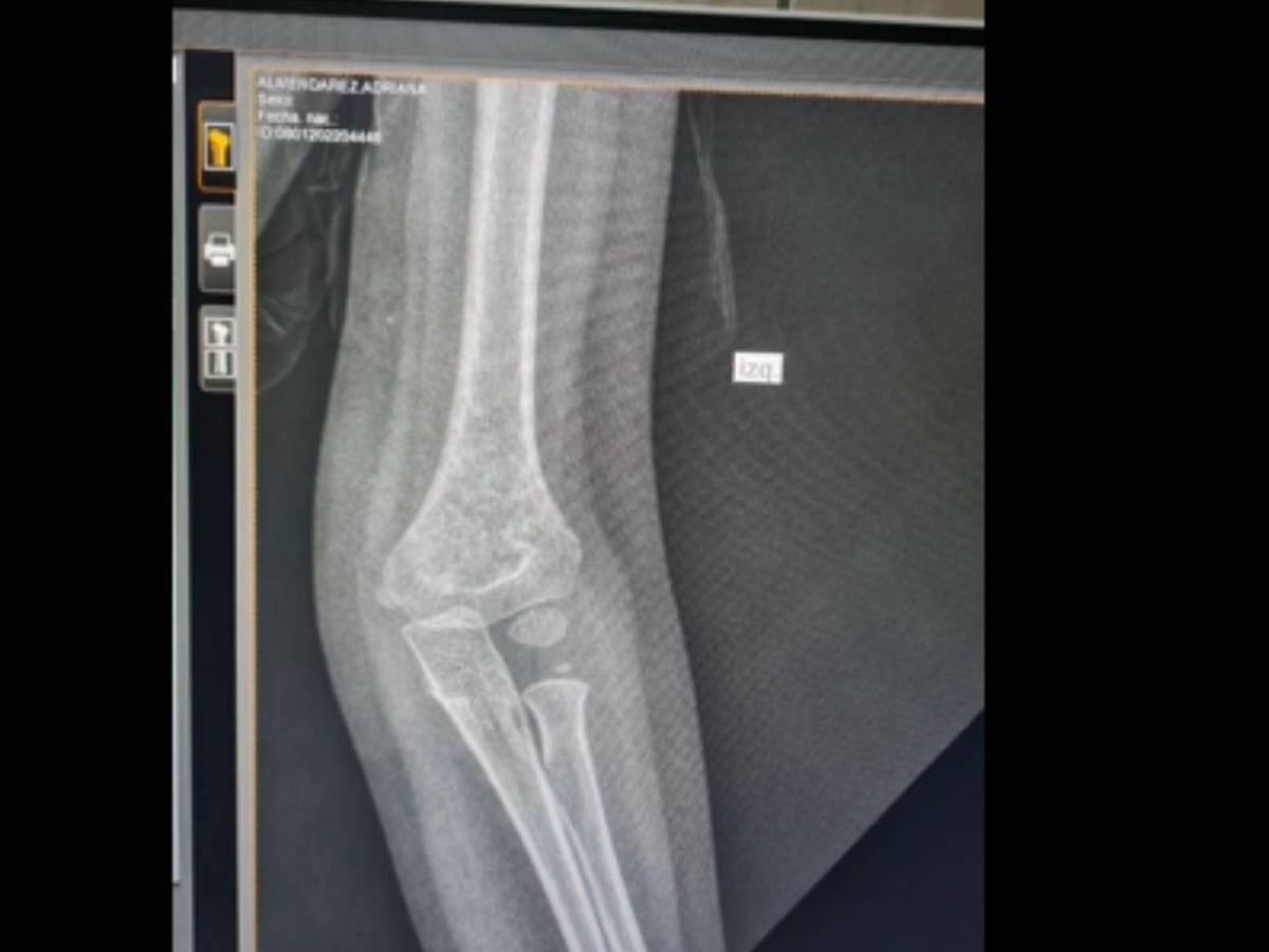 Ni radiografías, ni yesos: Francis Espinal denuncia impotente la falta de insumos en el IHSS