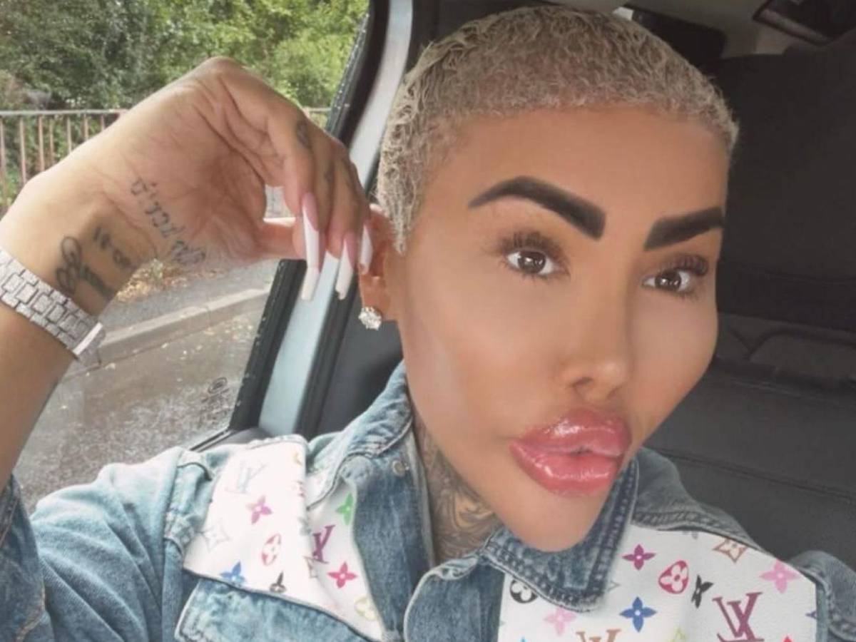 Muere el rey de los labios tras presuntas complicaciones por cirugía estética