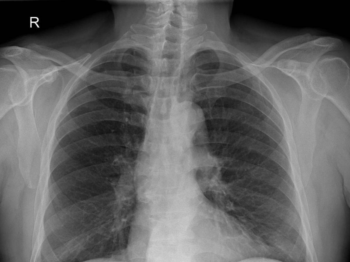 Niño recibió un corazón dañado en un trasplante y no podrá ser operado de nuevo, ¿cómo pasó?