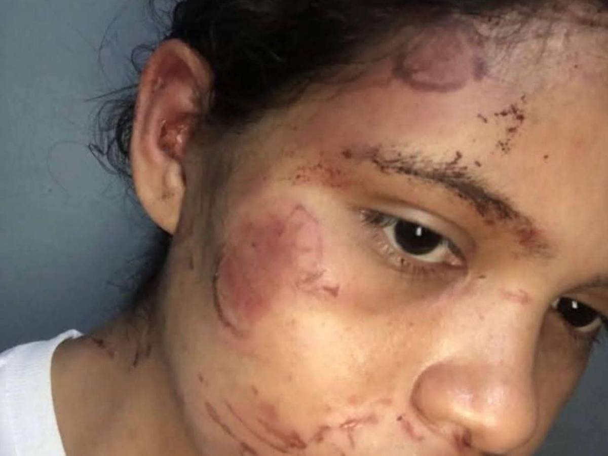Golpes y mordidas: mujer fue salvajemente atacada por su pareja en Olancho