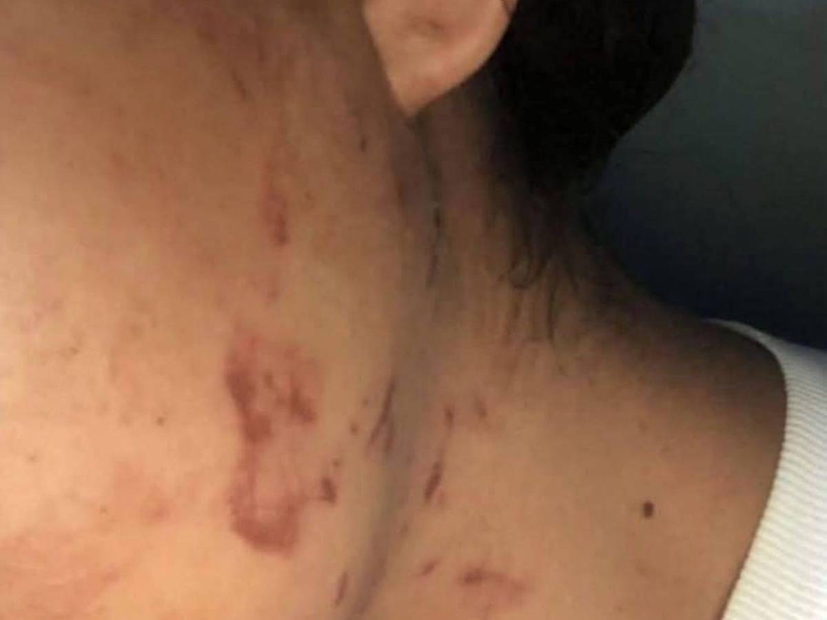 Golpes y mordidas: mujer fue salvajemente atacada por su pareja en Olancho