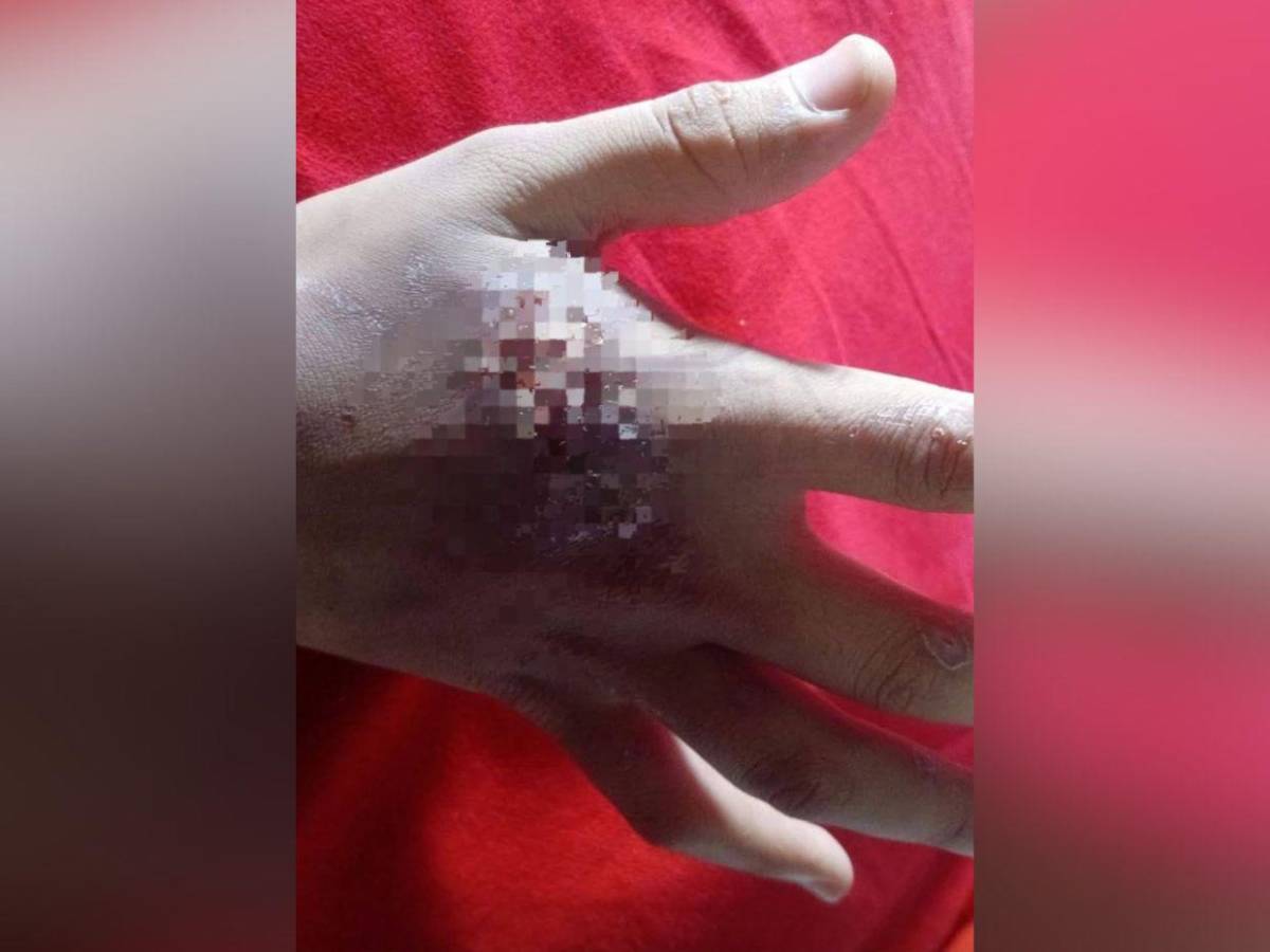 Golpes y mordidas: mujer fue salvajemente atacada por su pareja en Olancho