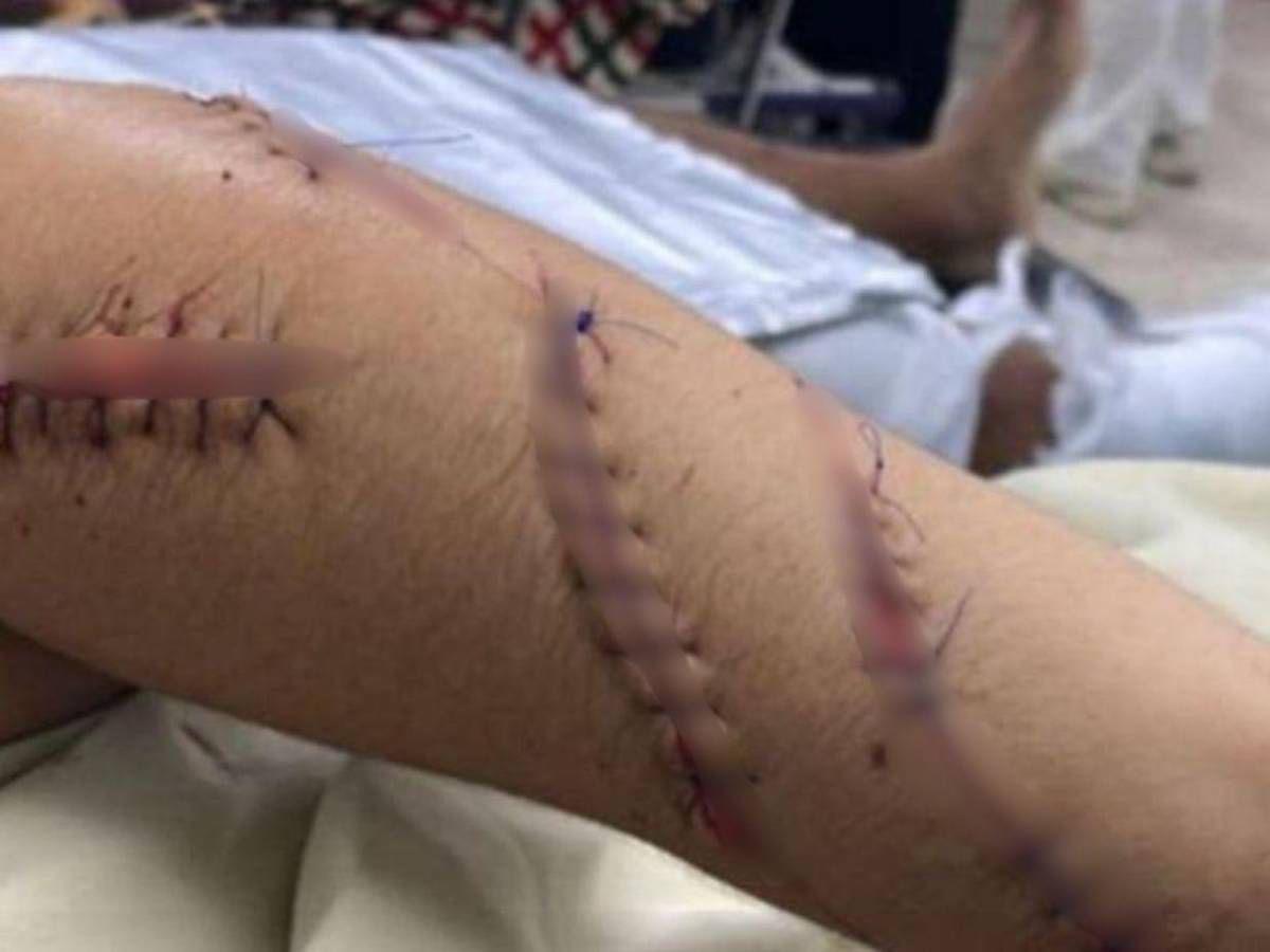 Recibió 30 machetazos: Yensy Guzmán quedó completamente desfigurada tras brutal ataque de su esposo