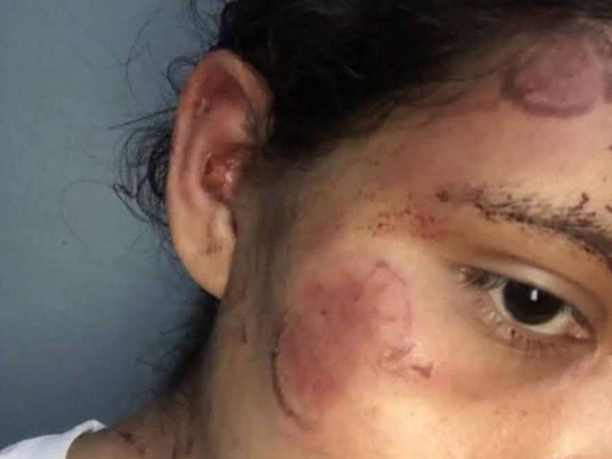 Golpes y mordidas: mujer fue salvajemente atacada por su pareja en Olancho