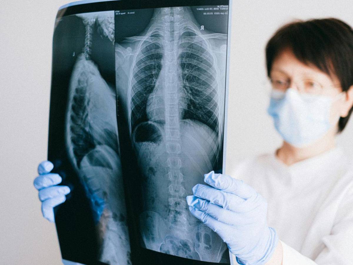 El cáncer de pulmón que afecta al papa León XIV: qué es el adenocarcinoma y cómo se trata