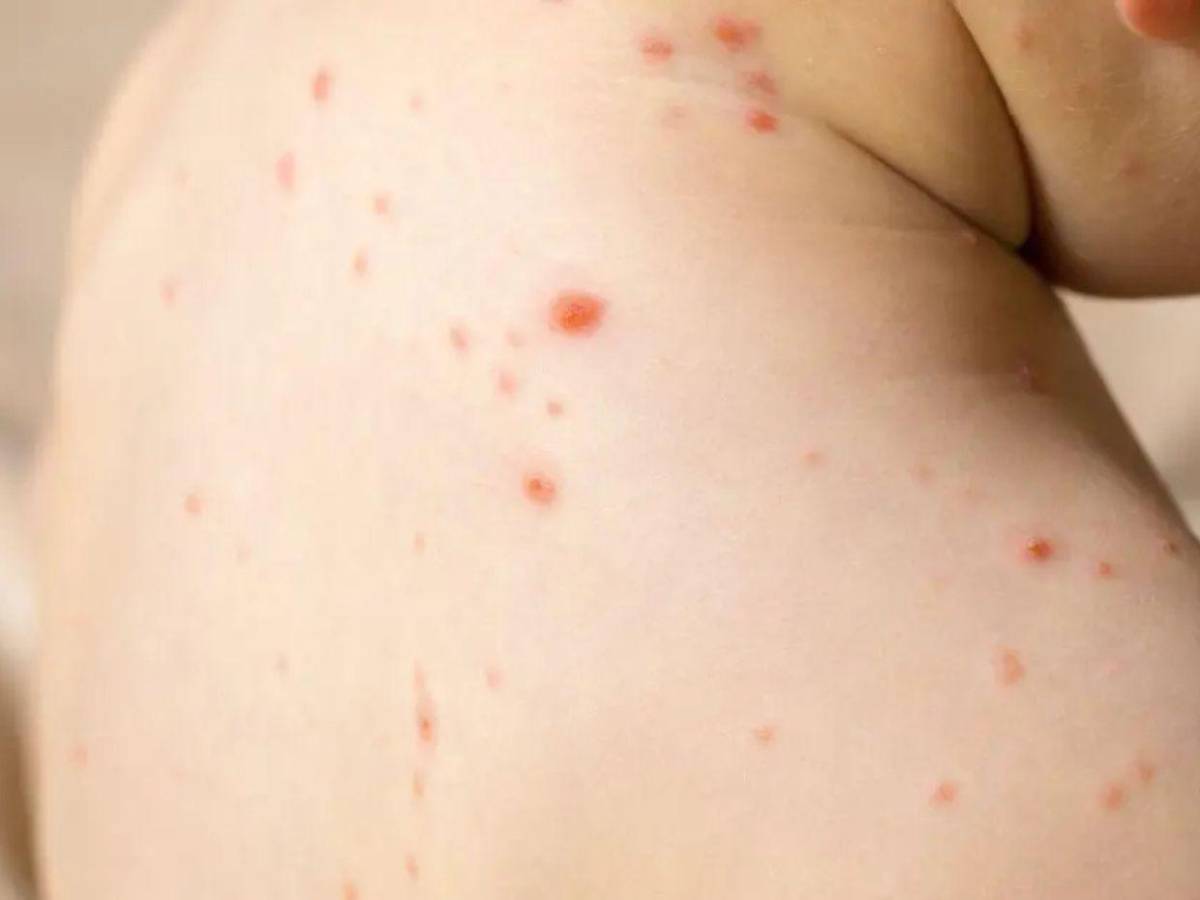 “Altamente contagiosa”: Riesgos de que vuelva el sarampión a Honduras, tras 29 años sin contagios