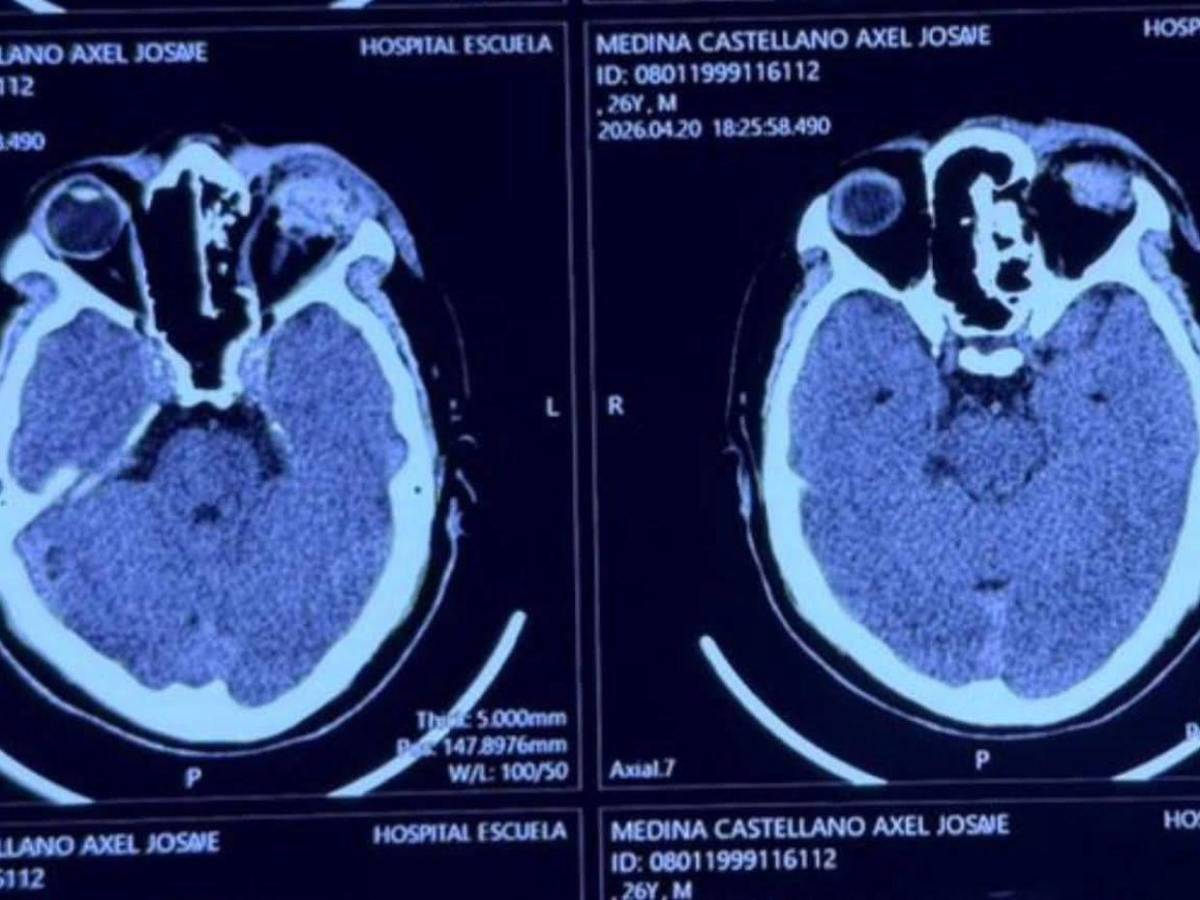 ¿Quién es el estudiante de la UNAH que perdió un ojo durante protesta en el Congreso?