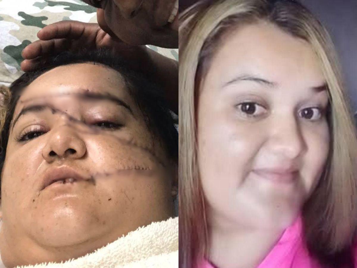 Recibió 30 machetazos: Yensy Guzmán quedó completamente desfigurada tras brutal ataque de su esposo