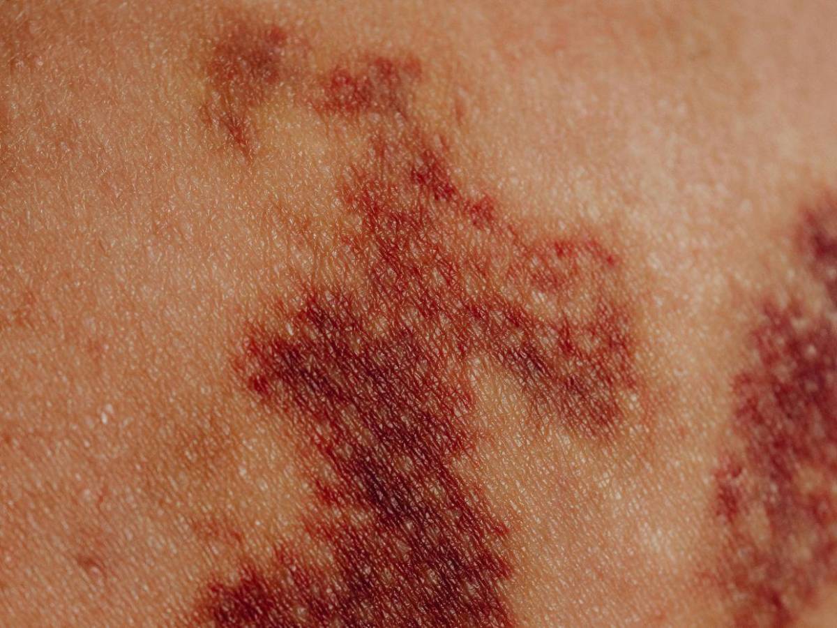 Menores de 2 años, viajeros y en zonas fronterizas: la vacuna es clave para prevenir el sarampión