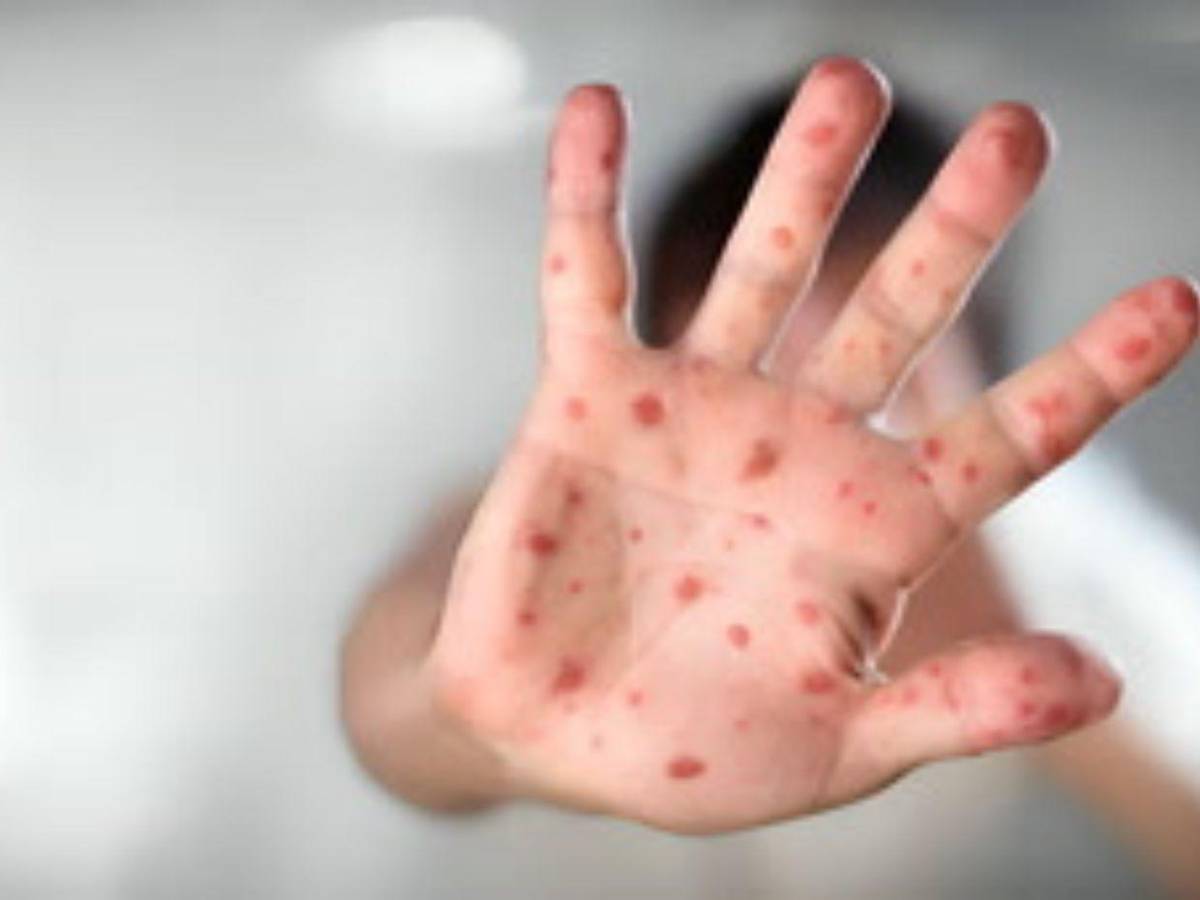 “Altamente contagiosa”: Riesgos de que vuelva el sarampión a Honduras, tras 29 años sin contagios