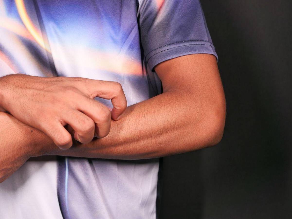 ¿Cuáles son los síntomas de la enfermedad del gusano barrenador en humanos?