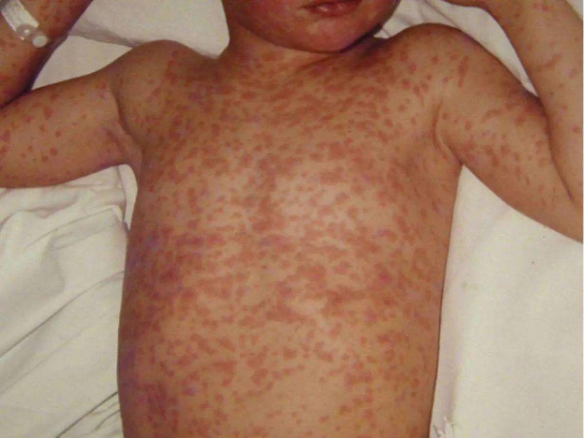 “Altamente contagiosa”: Riesgos de que vuelva el sarampión a Honduras, tras 29 años sin contagios