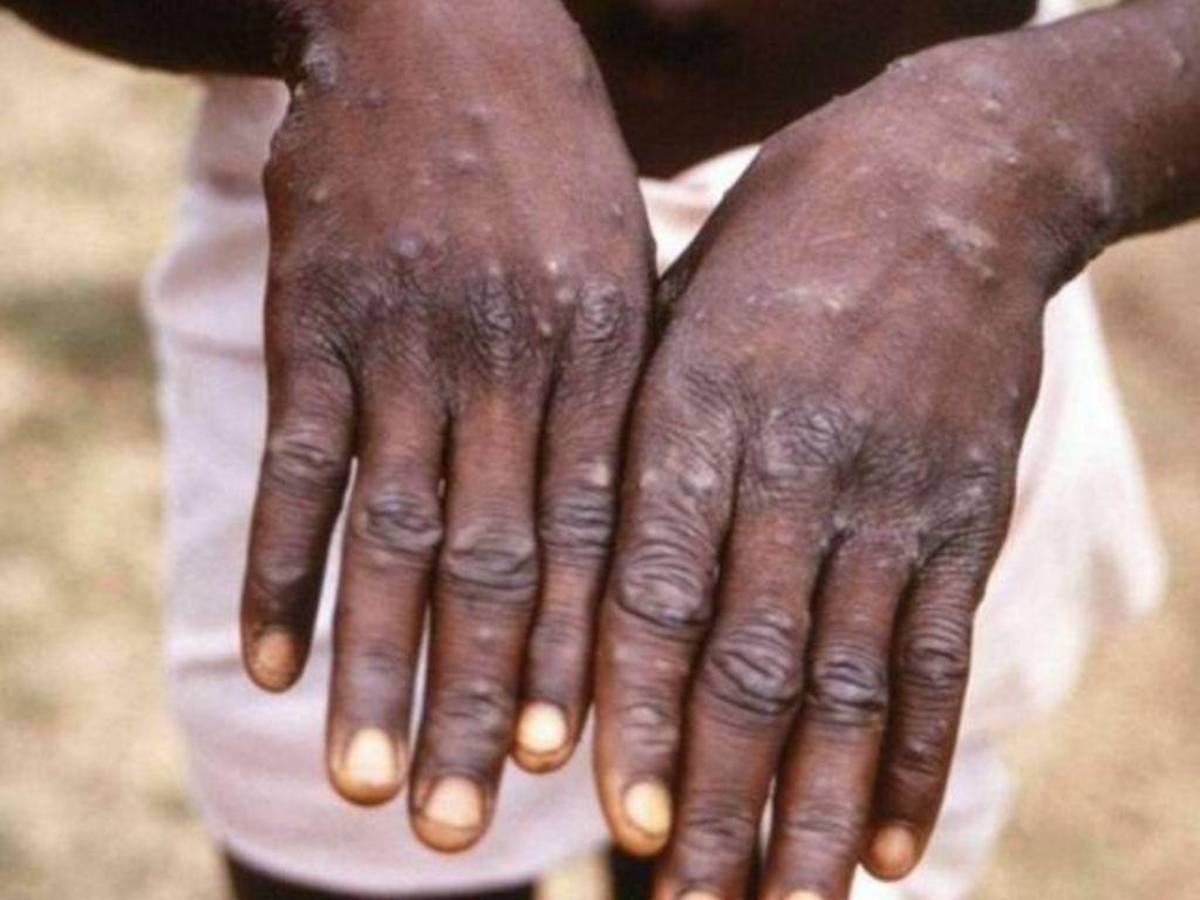 India informa de la muerte de un hombre contagiado con viruela del mono