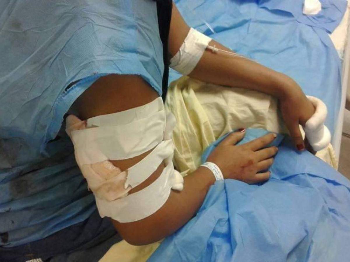 Más de 10 quemados por pólvora se registraron durante las fiestas de Fin de Año