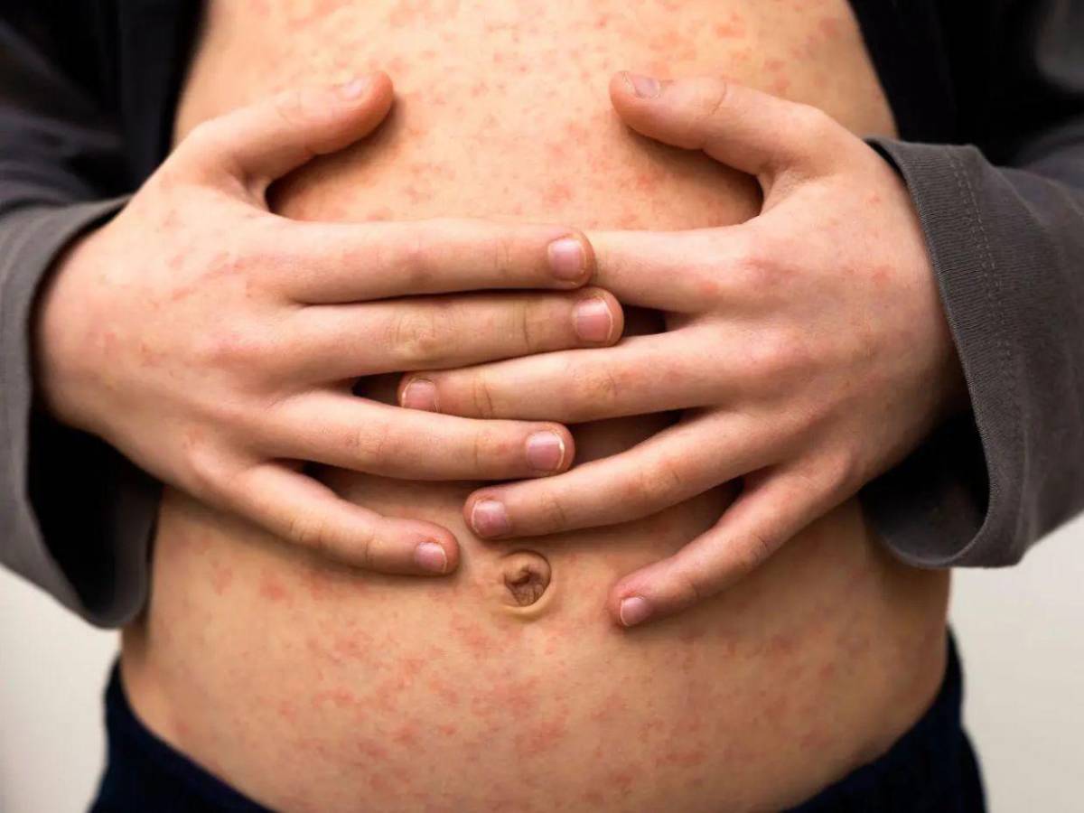 “Altamente contagiosa”: Riesgos de que vuelva el sarampión a Honduras, tras 29 años sin contagios