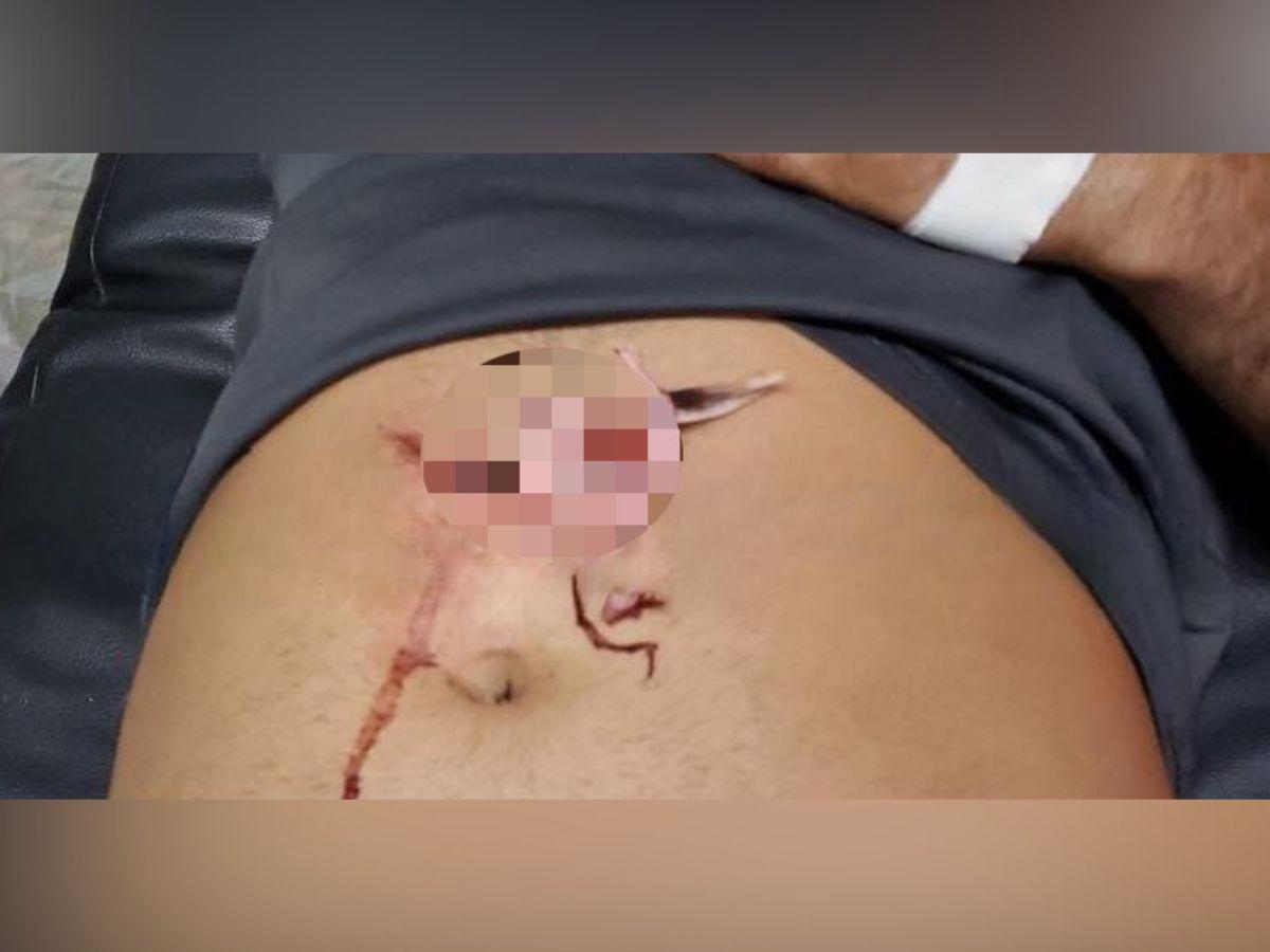 Hombre es ingresado al hospital con una aleta de pez en su estómago en Yoro