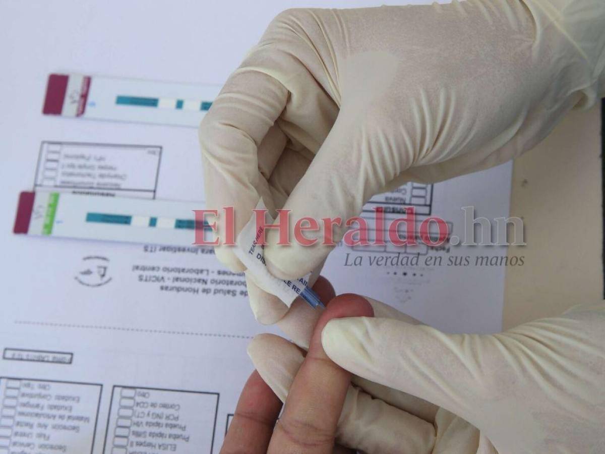 Salud intensifica vigilancia por hepatitis aguda en países vecinos