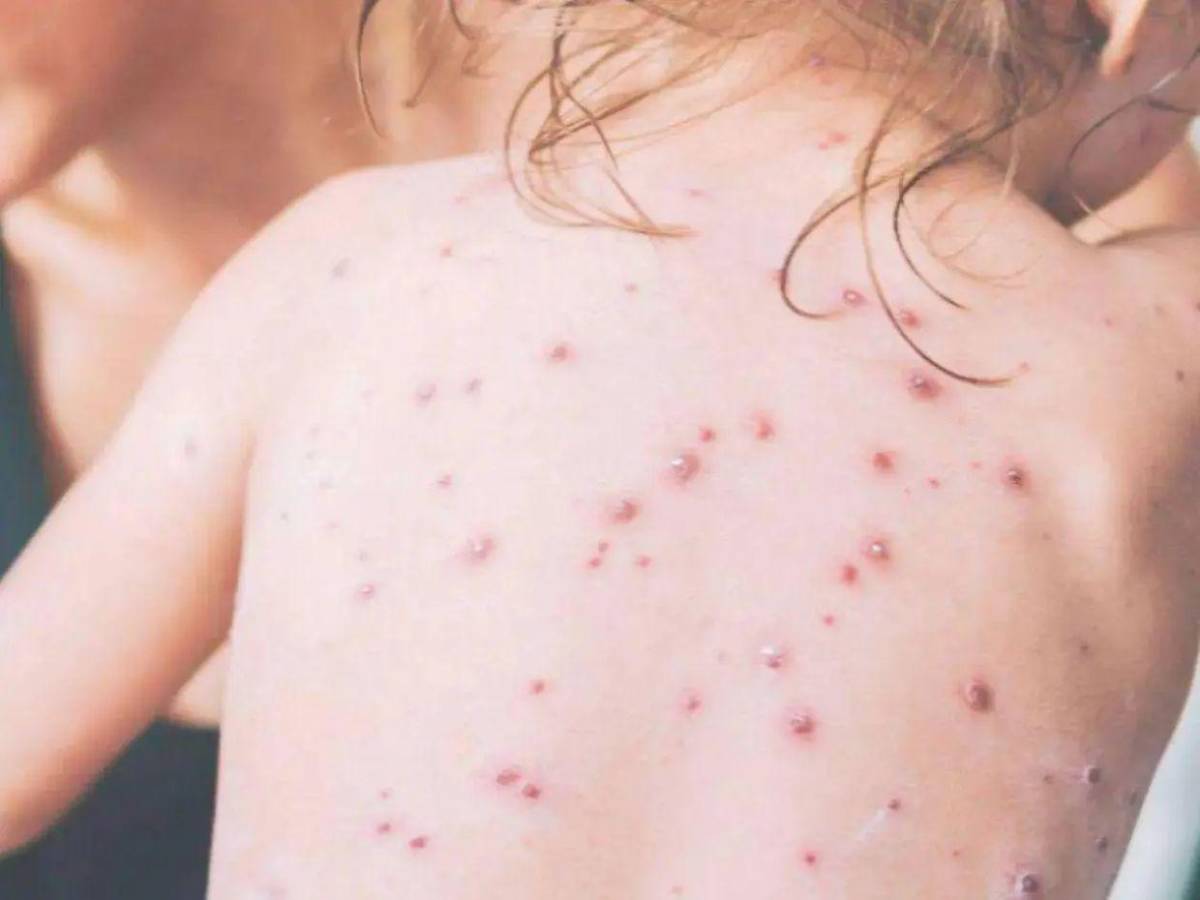 “Altamente contagiosa”: Riesgos de que vuelva el sarampión a Honduras, tras 29 años sin contagios