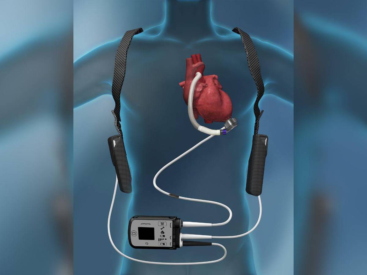 ¿Qué es el corazón artificial de L10.5 millones que necesita diputado de Libre para vivir?