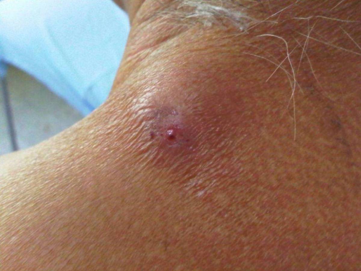 ¿Cuáles son los síntomas de la enfermedad del gusano barrenador en humanos?