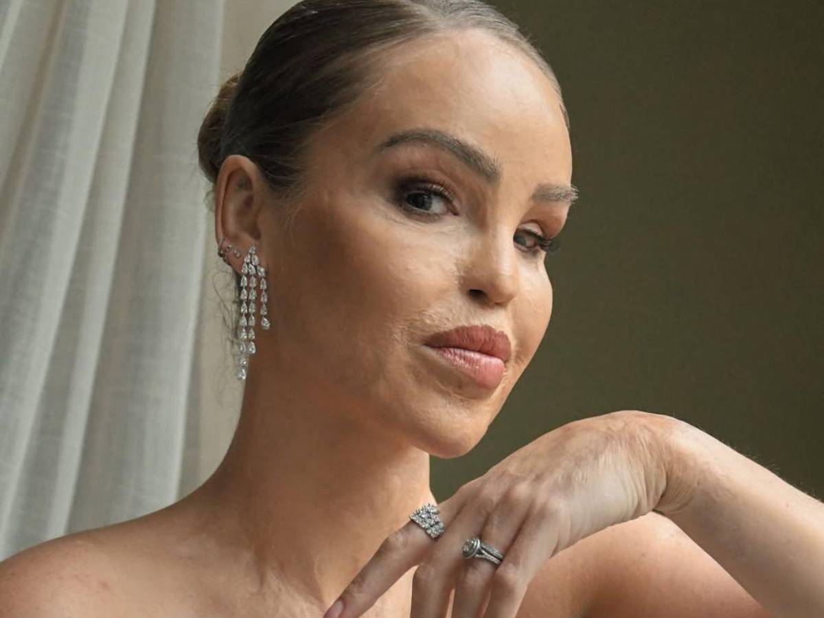 ¿Qué ha sido de Katie Piper, la presentadora a la que le tiraron ácido en la cara?