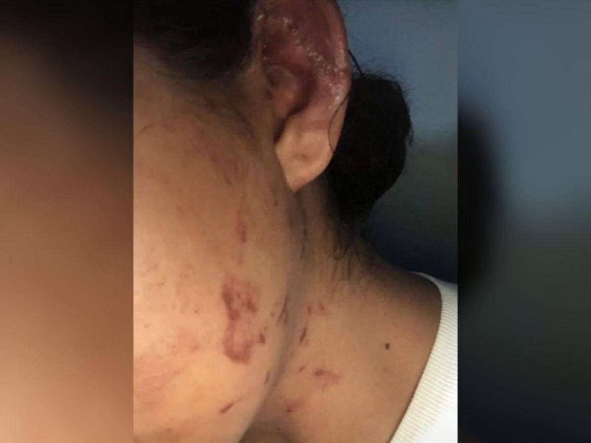 Tenía 40 días de haber parido: madre de Dayani Acosta, joven atacada a mordidas por su expareja