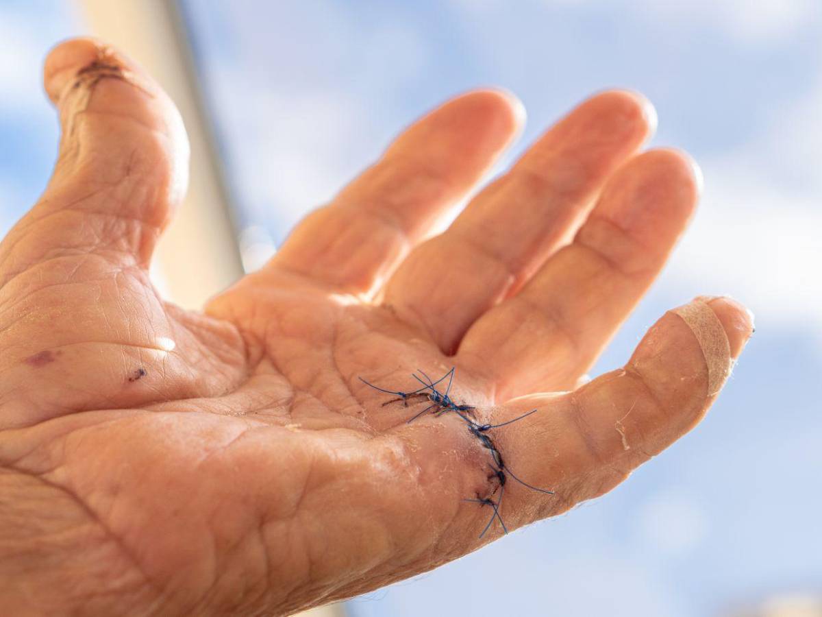 Visión borrosa y oscurecimiento de la piel: los síntomas de la diabetes mellitus que la mayoría ignora