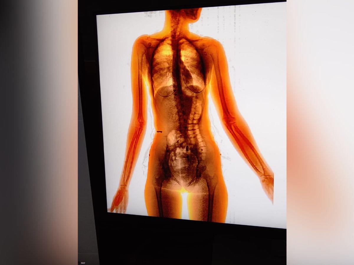 Este es el escáner que muestra la droga en el interior de la mujer.