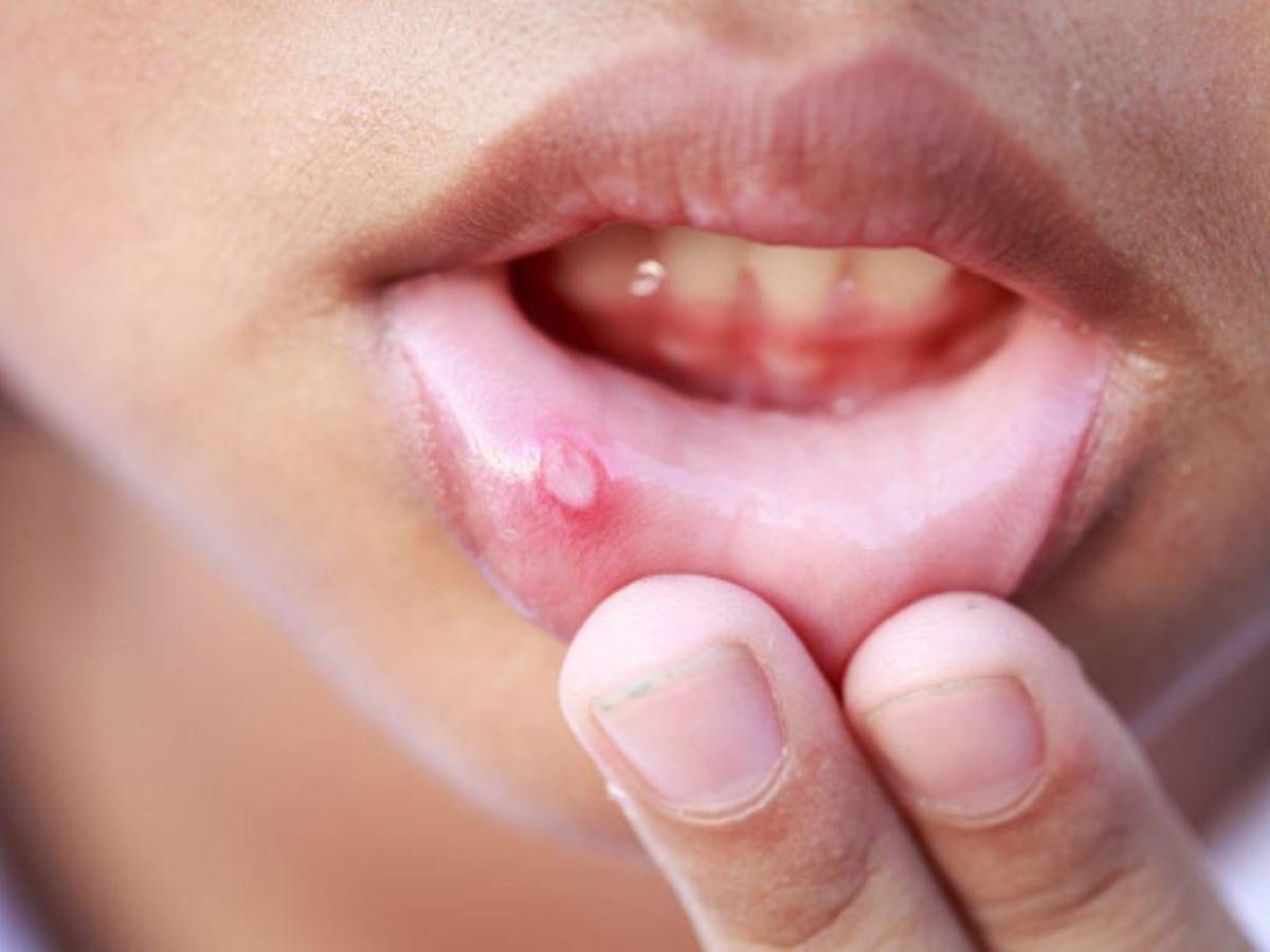 Remedios caseros para prevenir y tratar postemillas en la boca