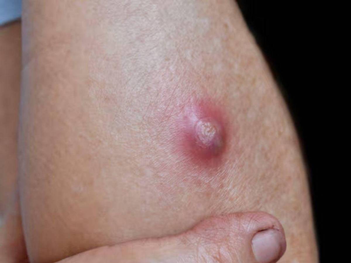 ¿Cuáles son los síntomas de la enfermedad del gusano barrenador en humanos?